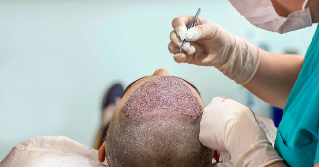Hair Transplant Benefits in India